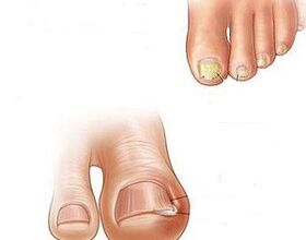 primele semne ale apariției unei ciuperci pe unghiile picioarelor